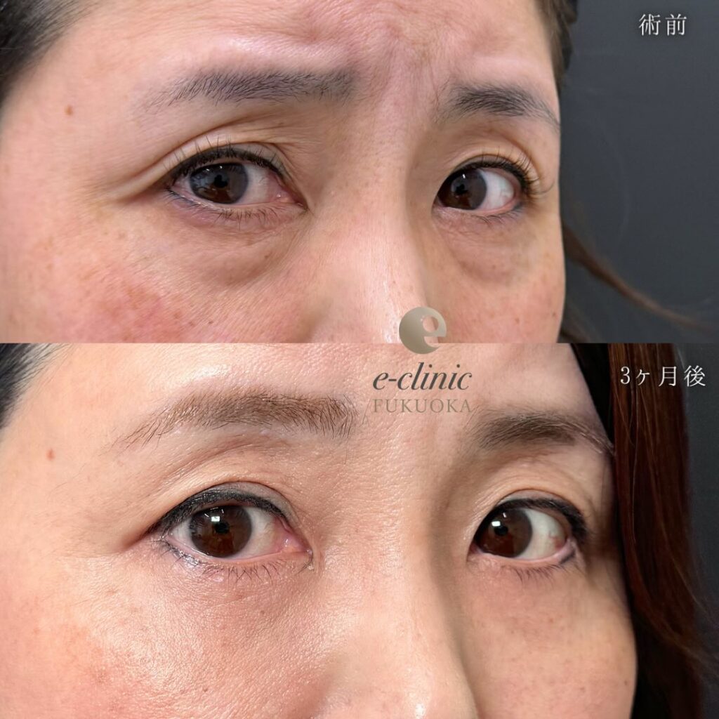 裏ハムラ法と目の下の脂肪注入と額とこめかみの脂肪注入の症例写真 (2)