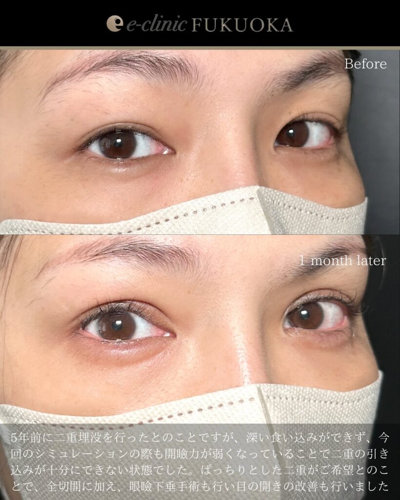 眼瞼下垂と全切開と涙袋のヒアルロン酸の症例写真 (4)