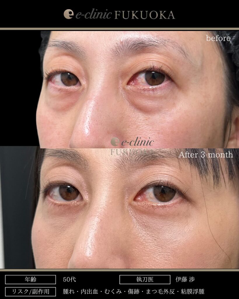 裏ハムラ法の症例写真 (93)