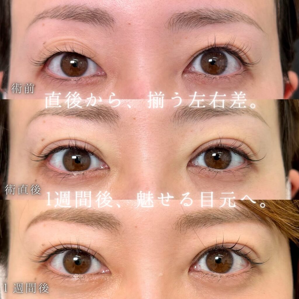 埋没法と他院修正の症例写真 (2)