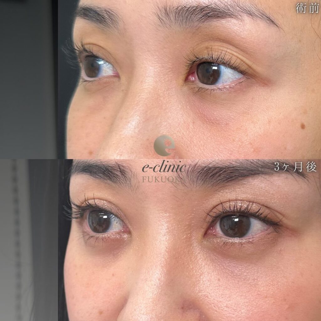 裏ハムラ法と埋没法の症例写真 (3)