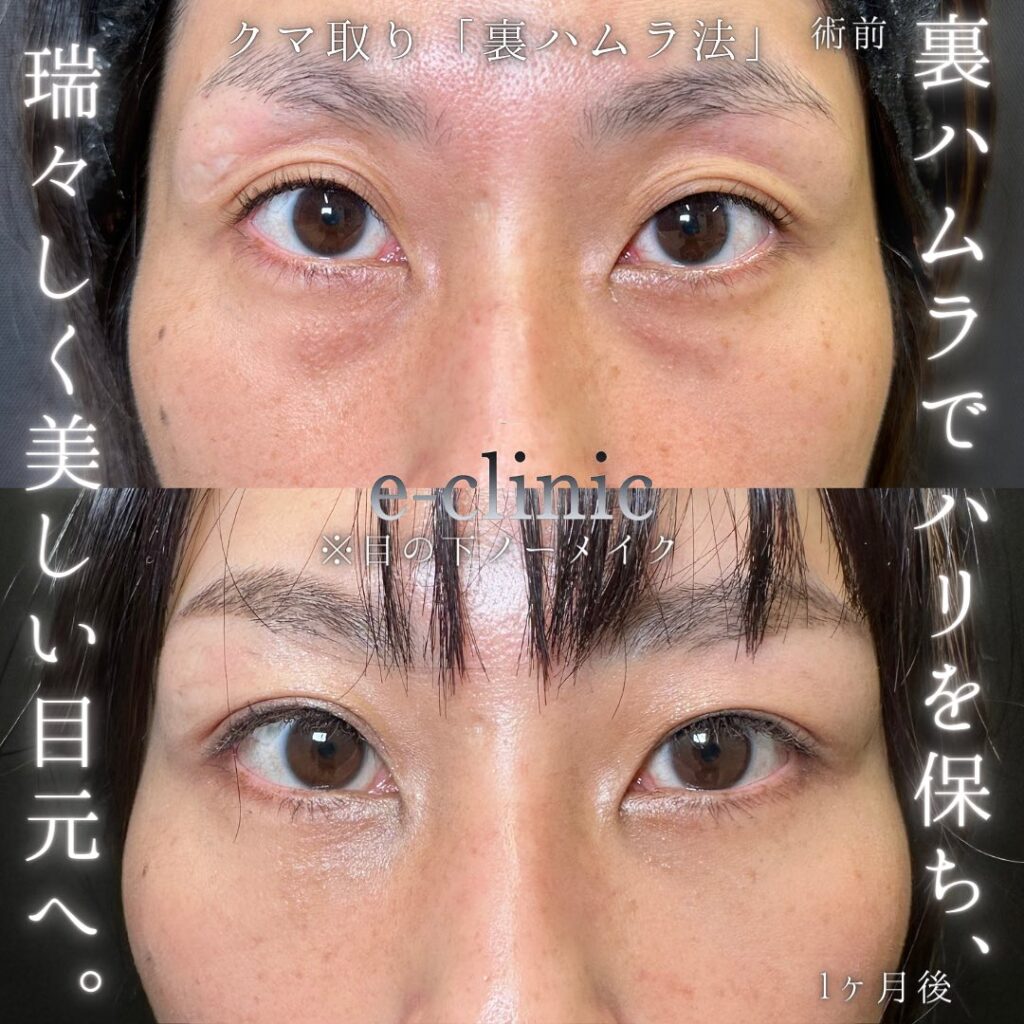 裏ハムラ法の症例写真 (52)