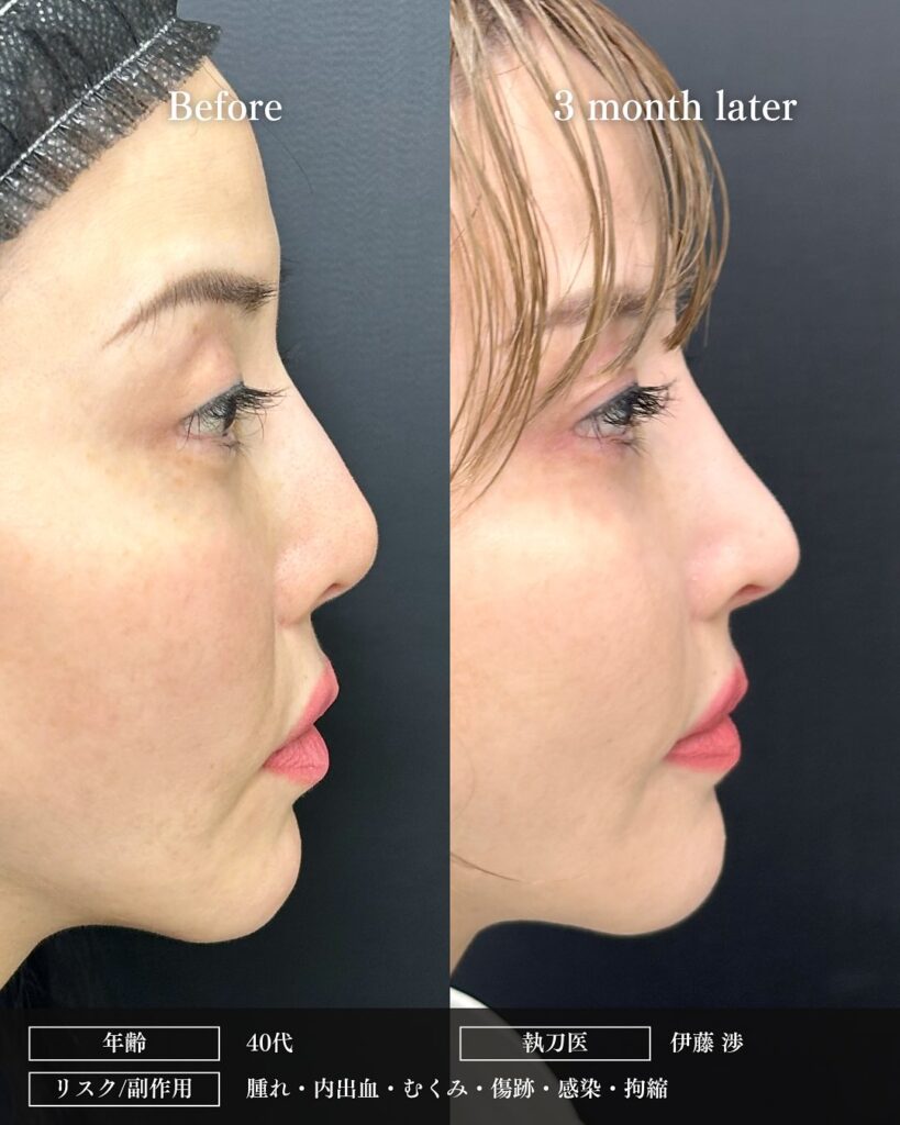 鼻尖形成と軟骨移植とプロテーゼ入れ替えの症例写真 (3)