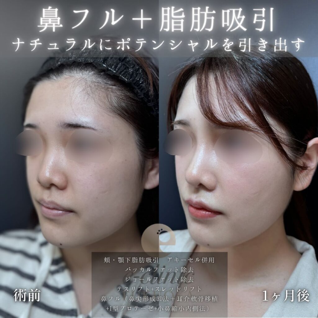 頬と顎下の脂肪吸引とバッカルファットとジョールファットと糸リフトと鼻尖形成と軟骨移植とプロテーゼと小鼻縮小の症例写真 (1)