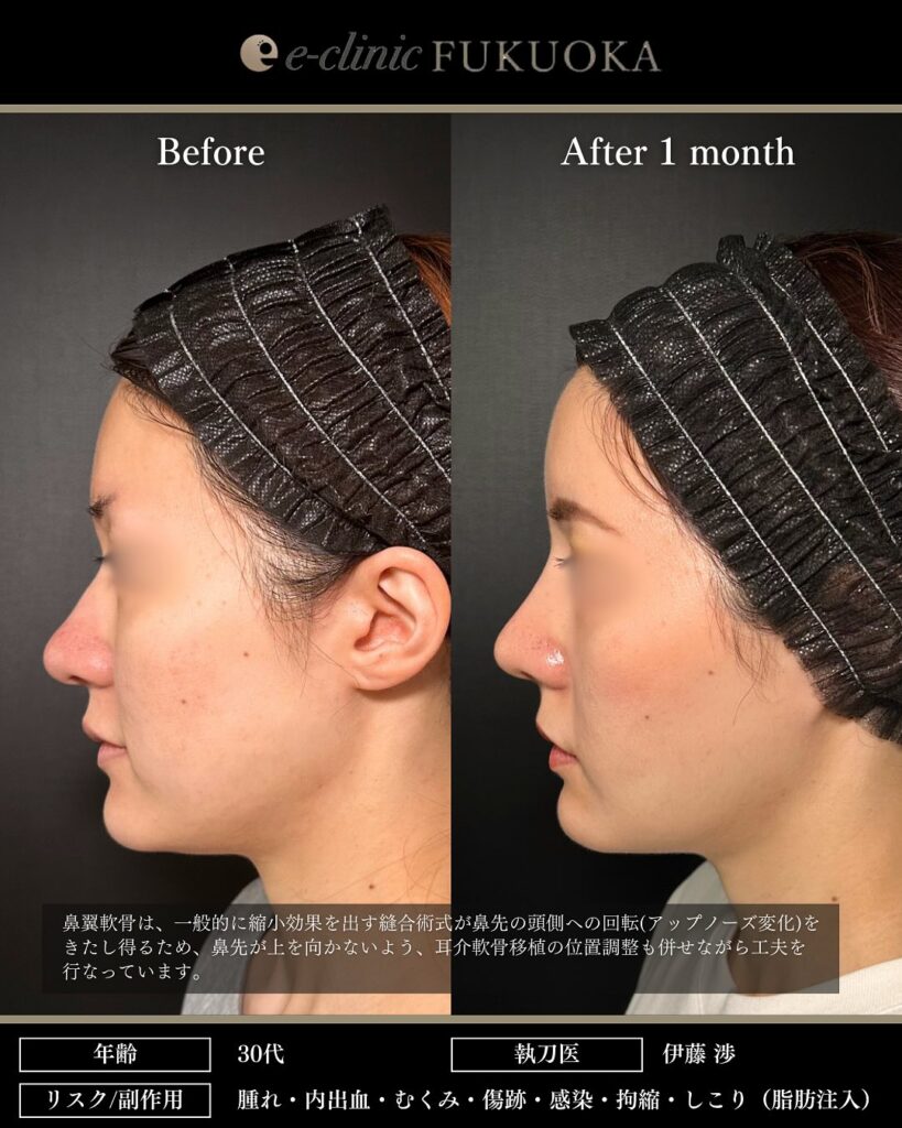 鼻尖形成と軟骨移植と小鼻縮小とプロテーゼと額とこめかみの脂肪注入と頬の脂肪吸引とジョールファットと糸リフトの症例写真 (4)