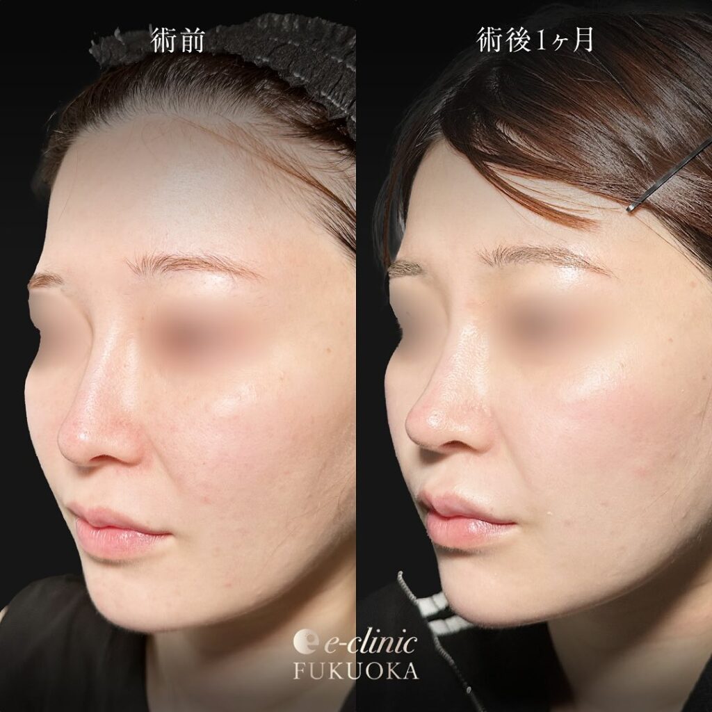 鼻尖形成と軟骨移植の症例写真 (15)