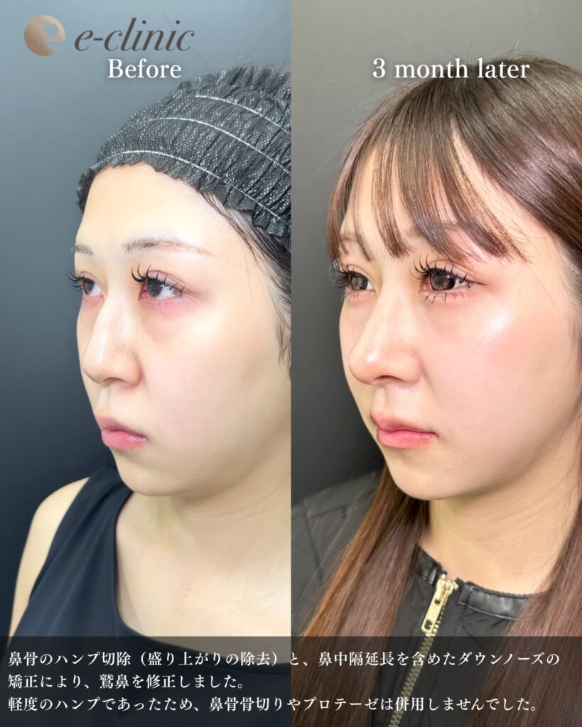 鼻中隔延長と鼻尖形成と軟骨移植と鷲鼻修正の症例写真 (11)