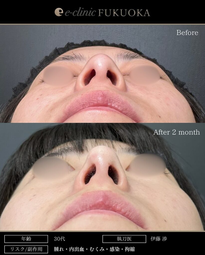 鼻尖形成と軟骨移植の症例写真 (24)