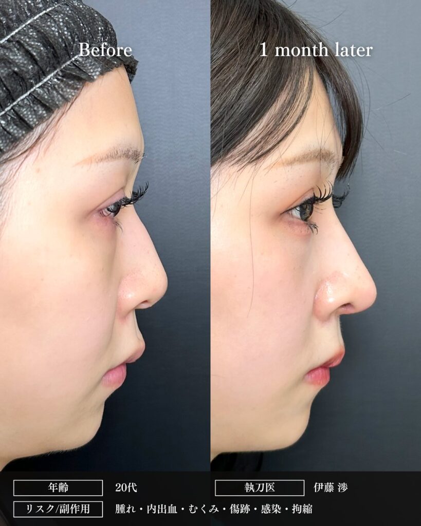 腫れ、内出血、むくみ、傷跡、痛みを生じる事があります。 なるべく、リスクや副作用が出ないように配慮して手術を行っています。