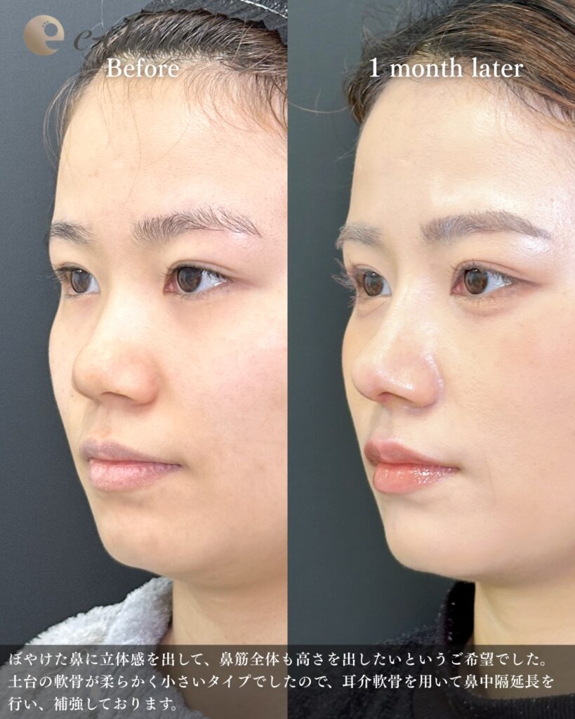 鼻中隔延長と鼻尖形成と軟骨移植と鼻柱下降とプロテーゼの症例写真 (7)