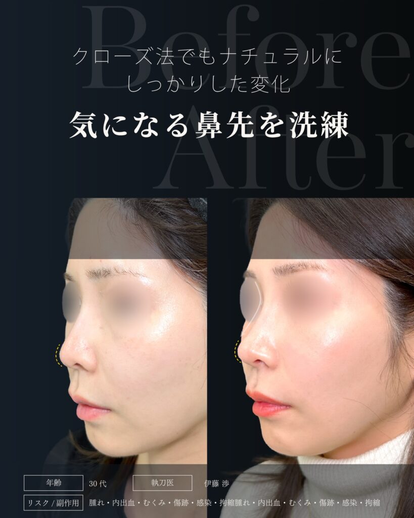 鼻尖形成と軟骨移植の症例写真 (38)