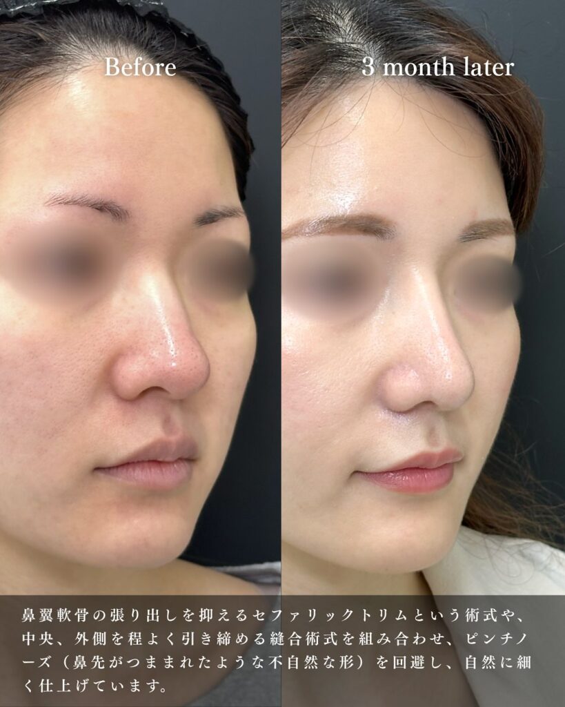 鼻尖形成と軟骨移植とプロテーゼと小鼻縮小と脂肪注入と頬の脂肪吸引とジョールファットと糸リフトの症例写真 (5)
