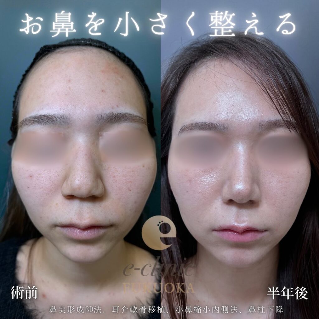 鼻尖形成と軟骨移植と小鼻縮小と小鼻縮小と鼻柱下降の症例写真 (1)