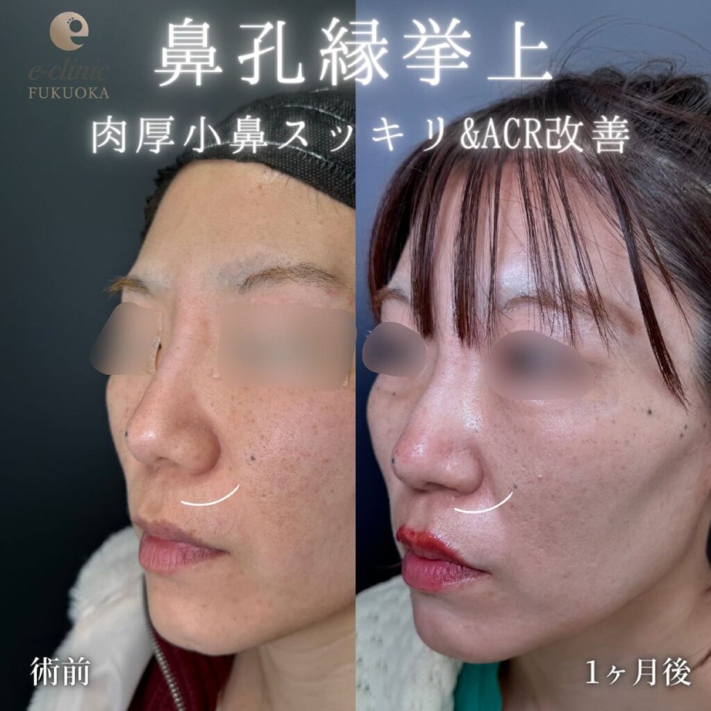 鼻孔縁挙上の症例写真