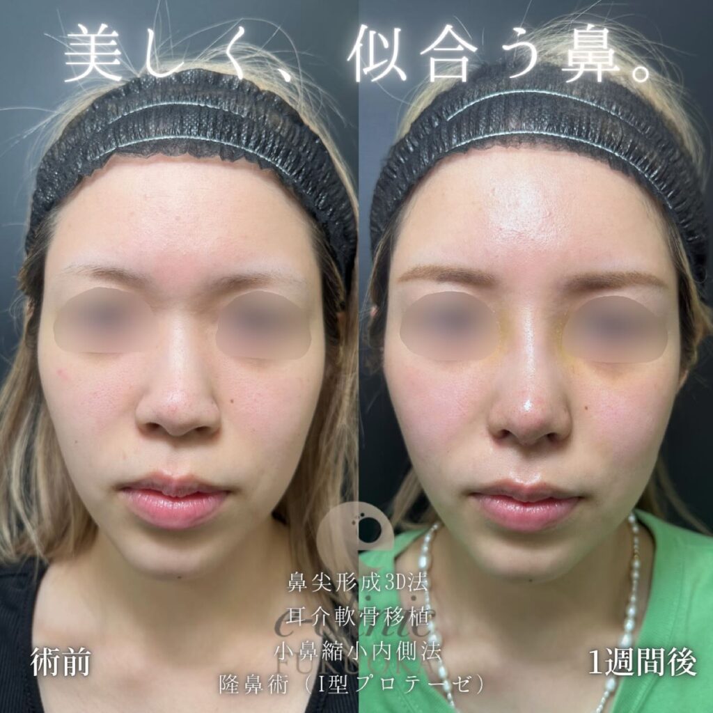 鼻尖形成と軟骨移植と小鼻縮小とプロテーゼの症例写真
