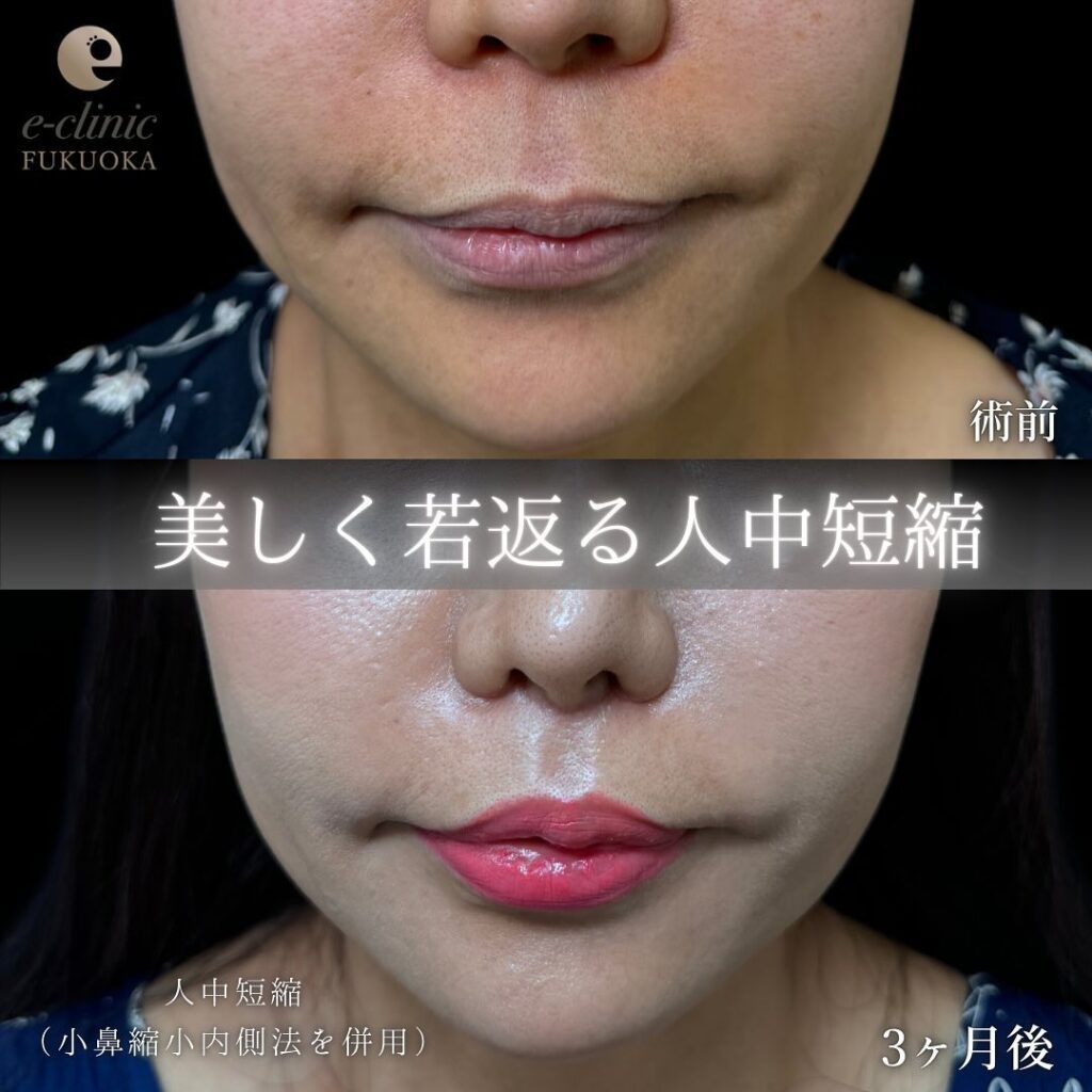 人中短縮と小鼻縮小の症例写真 (1)