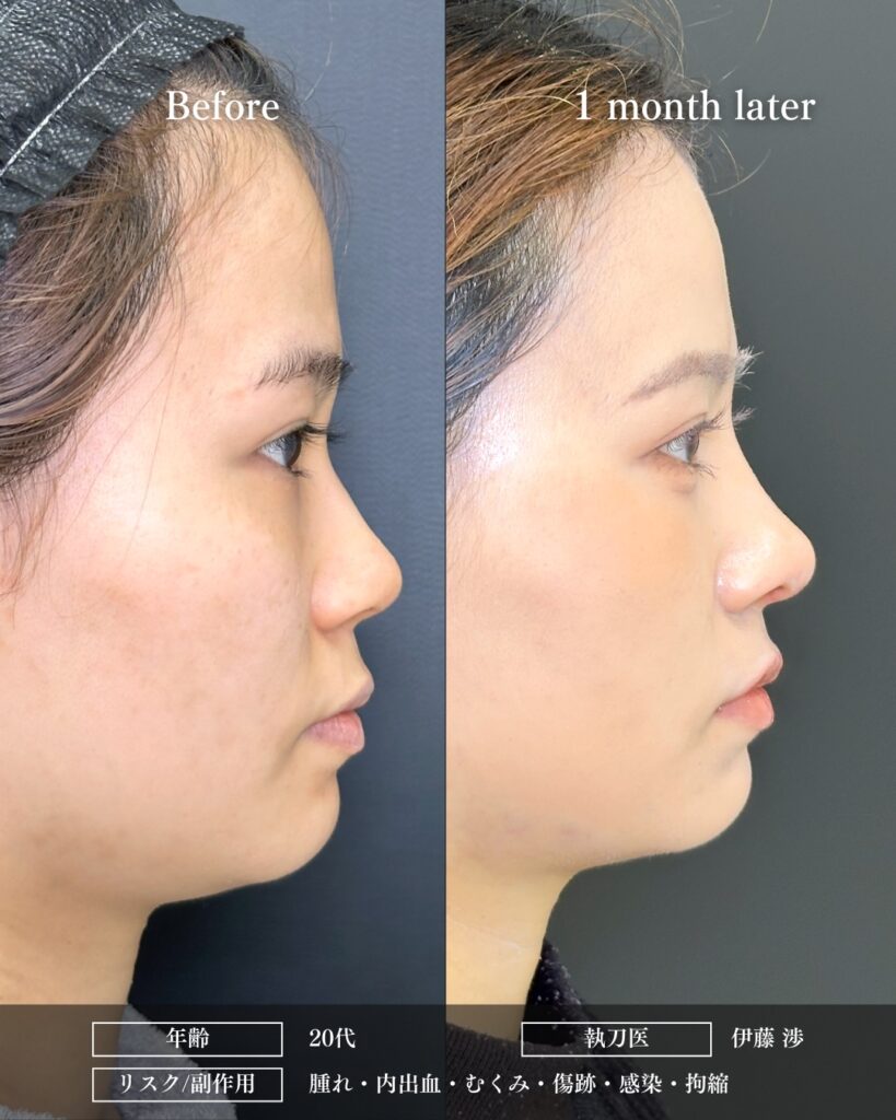 鼻中隔延長と鼻尖形成と軟骨移植と鼻柱下降とプロテーゼの症例写真 (2)