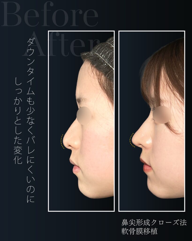 鼻尖形成と軟骨移植の症例写真 (34)