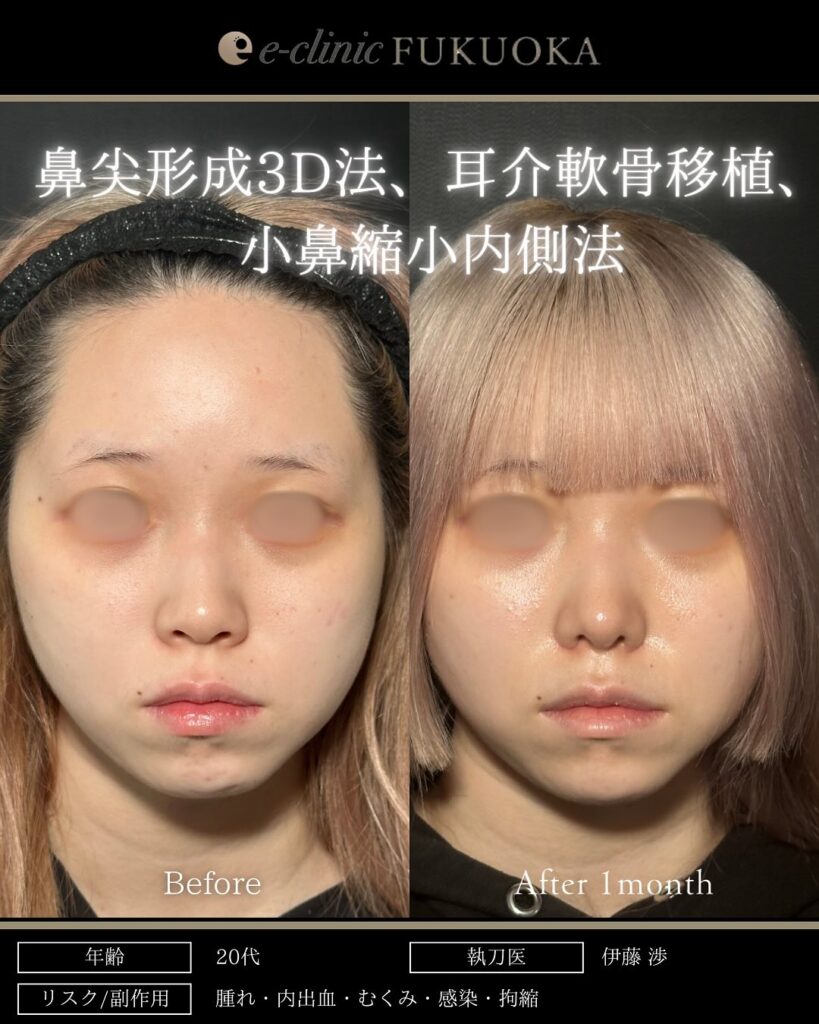 鼻尖形成と軟骨移植と小鼻縮小の症例写真 (16)