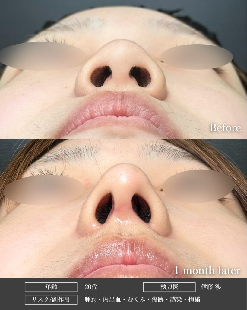 鼻尖形成と鼻中隔延長と耳介軟骨移植とプロテーゼと小鼻縮小の症例写真 (2)