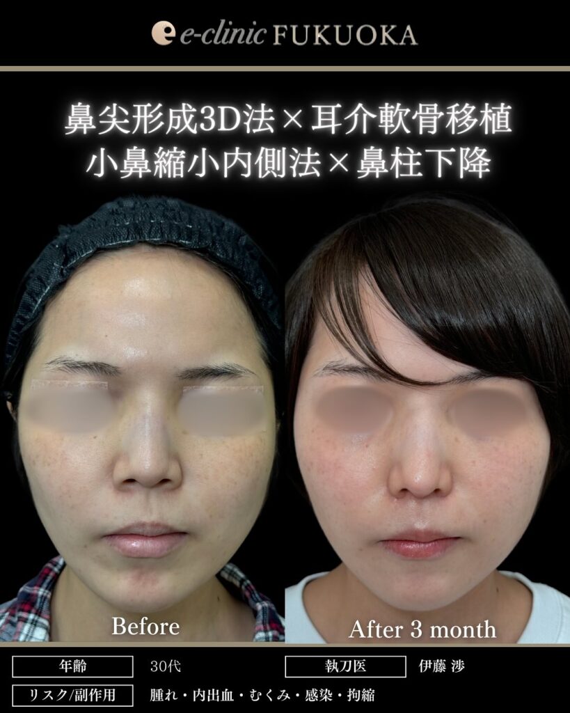 鼻尖形成と軟骨移植と小鼻縮小と鼻柱下降の症例写真 (1)