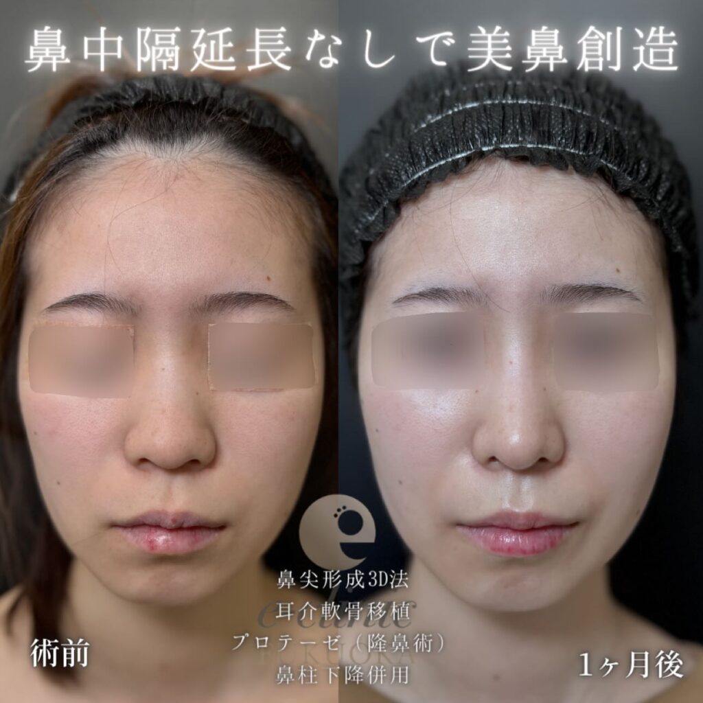 鼻尖形成と耳介軟骨移植とプロテーゼと鼻柱下降の症例写真 (4)