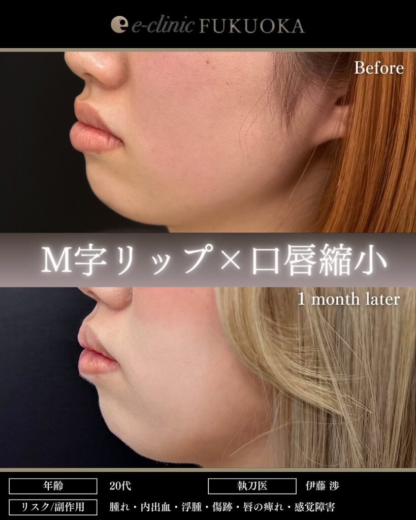 M字リップ+唇縮小の症例写真 (2)