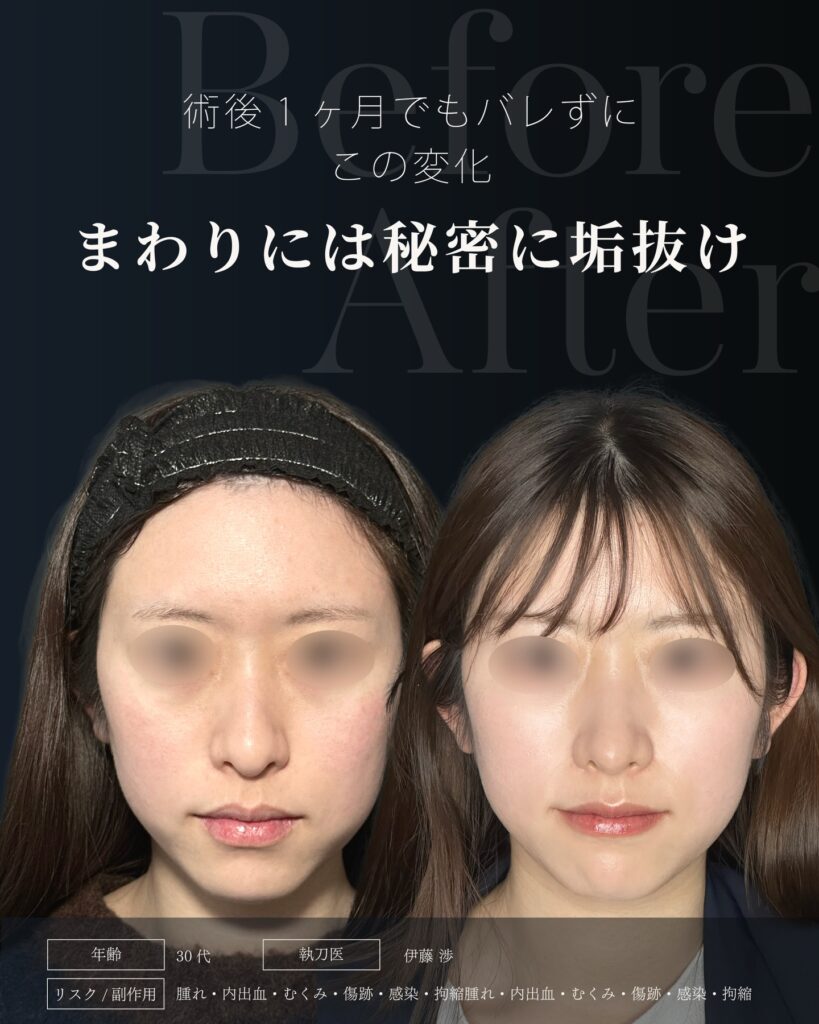 鼻尖形成と軟骨移植の症例写真 (33)