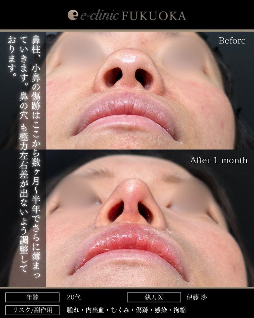 鼻尖形成と軟骨移植と小鼻縮小の症例写真 (20)