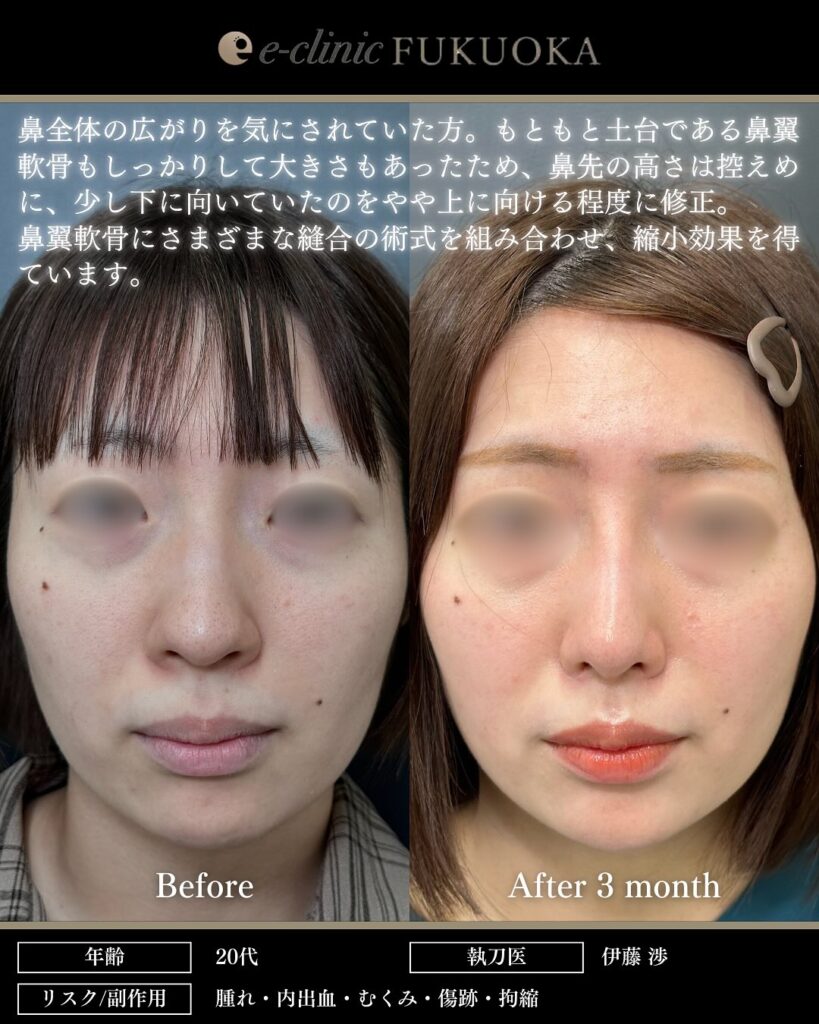 鼻尖形成と耳介軟骨移植とプロテーゼと小鼻縮小の症例写真 (3)