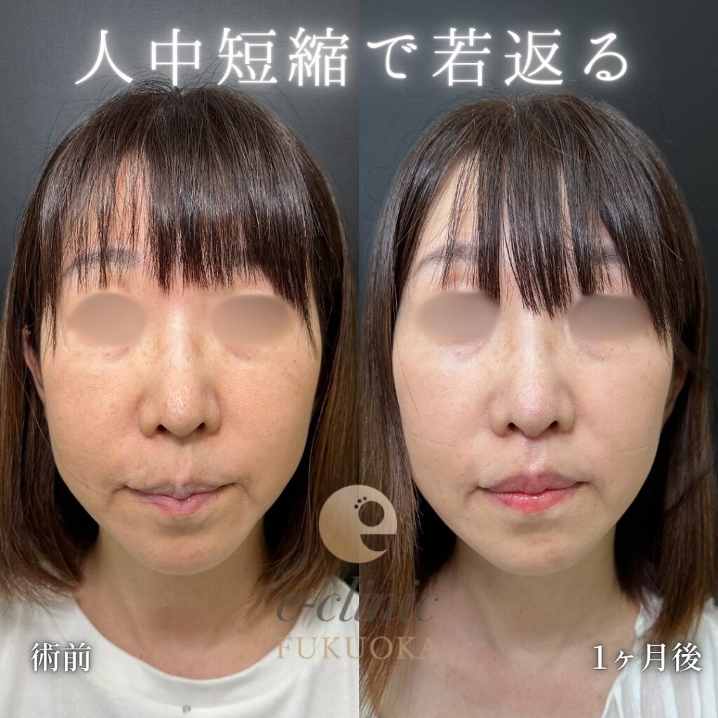 人中短縮の症例写真 (5)