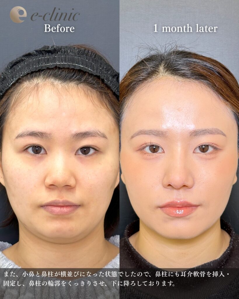 鼻中隔延長と鼻尖形成と軟骨移植と鼻柱下降とプロテーゼの症例写真 (6)