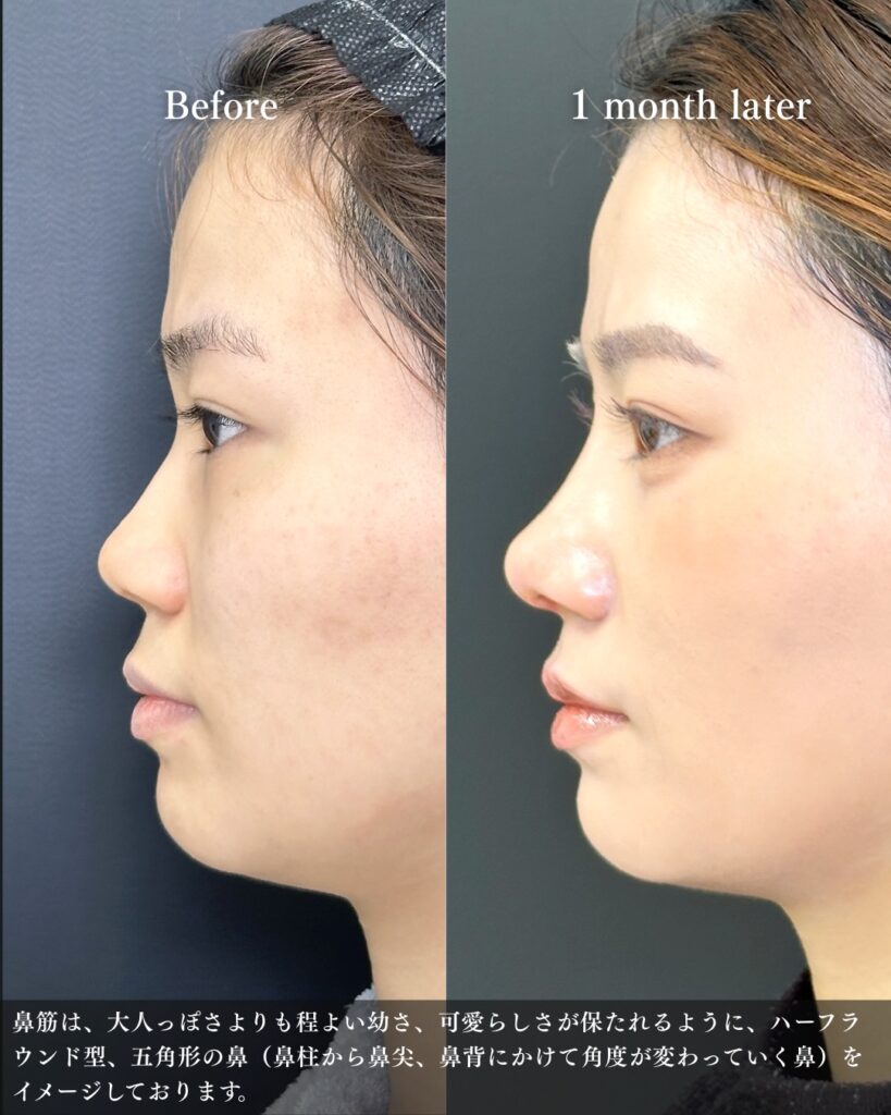 鼻中隔延長と鼻尖形成と軟骨移植と鼻柱下降とプロテーゼの症例写真 (5)