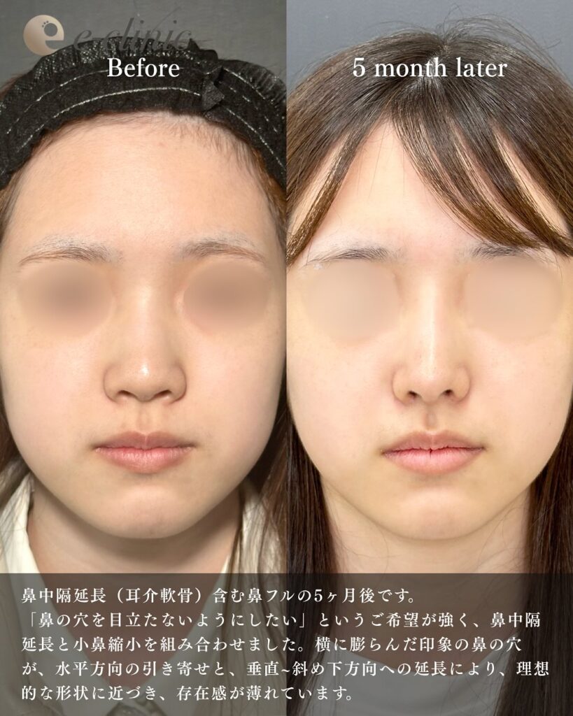 鼻中隔延長と鼻尖形成と耳介軟骨とプロテーゼと小鼻縮小と小鼻ボトックスの症例写真 (7)