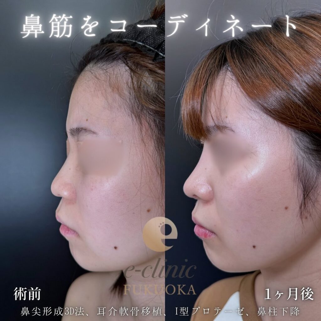 鼻尖形成と軟骨移植とプロテーゼと鼻柱下降の症例写真 (6)