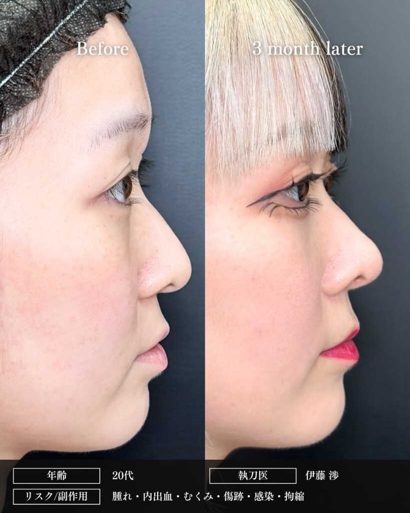 鼻中隔延長と鼻尖形成と軟骨移植と小鼻縮小の症例写真 (8)