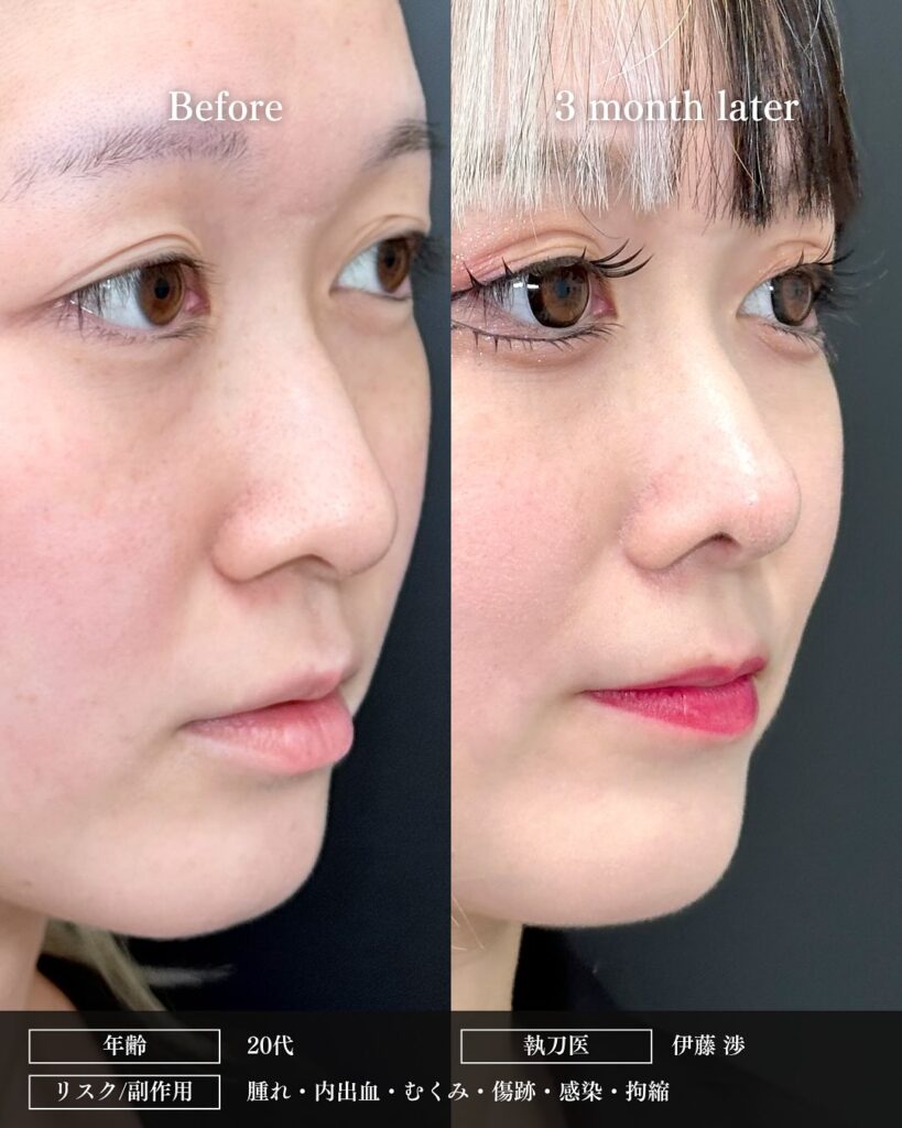 鼻中隔延長と鼻尖形成と軟骨移植と小鼻縮小の症例写真 (9)