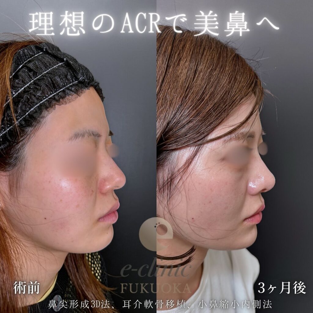 鼻尖形成と軟骨移植と小鼻縮小の症例写真 (15)