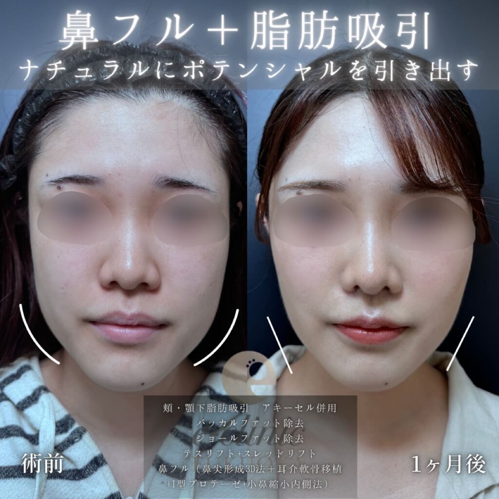 頬と顎下の脂肪吸引とバッカルファットとジョールファットと糸リフトと鼻尖形成と軟骨移植とプロテーゼと小鼻縮小の症例写真 (3)