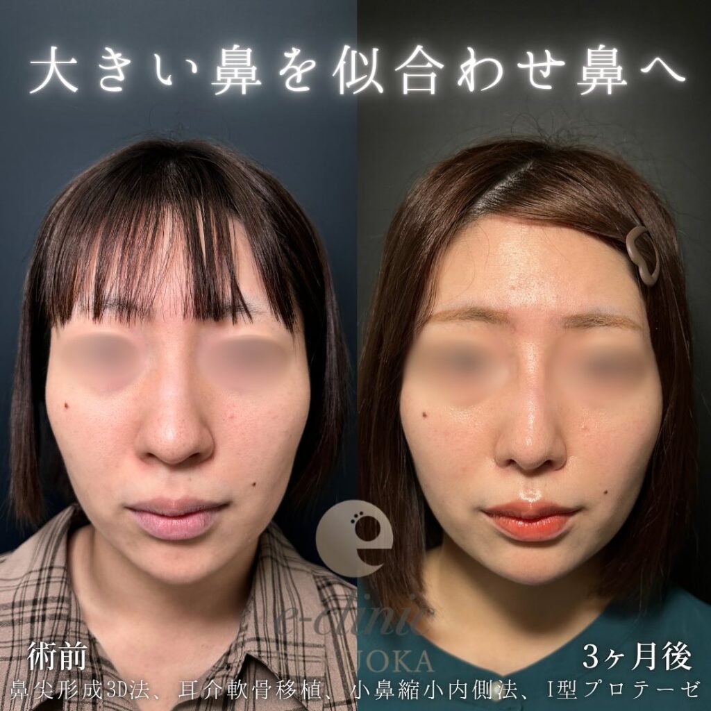 鼻尖形成と軟骨移植と小鼻縮小とプロテーゼの症例写真 (4)