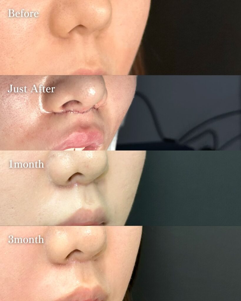 人中短縮の症例写真 (25)