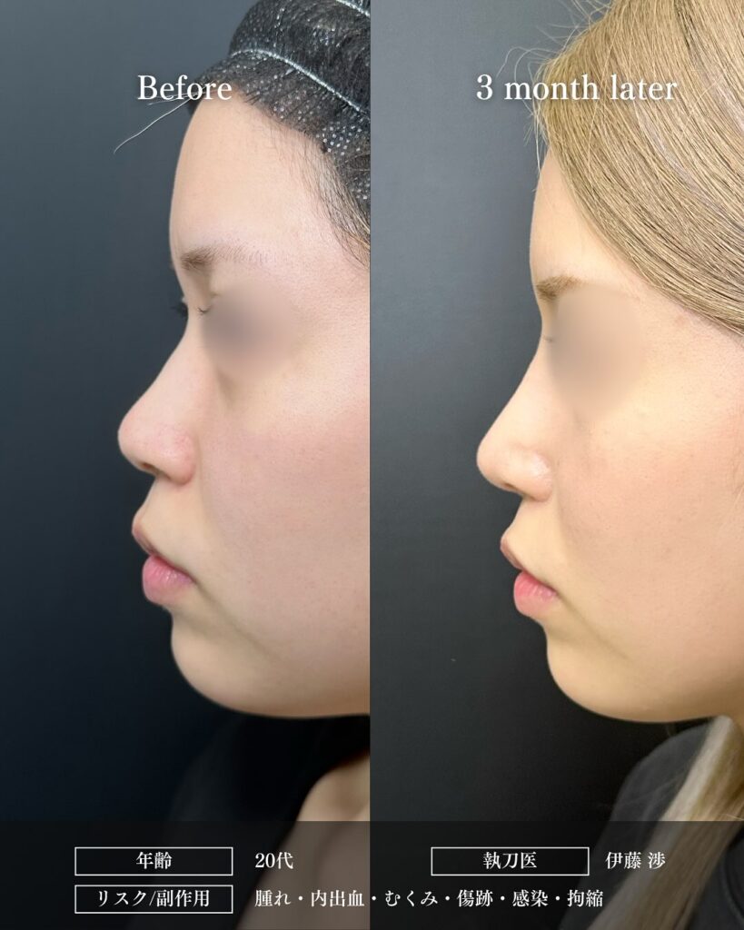 鼻尖形成と軟骨移植とプロテーゼと小鼻縮小の症例写真 (14)