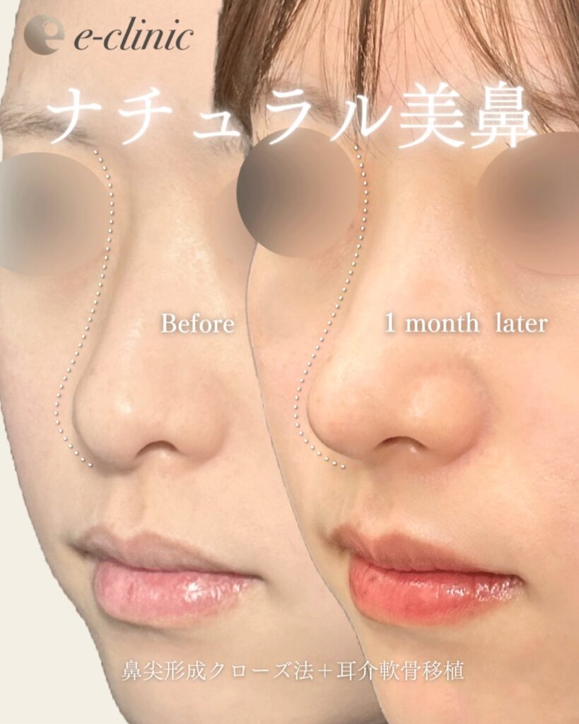 鼻尖形成と軟骨移植とプロテーゼの症例写真 (12)
