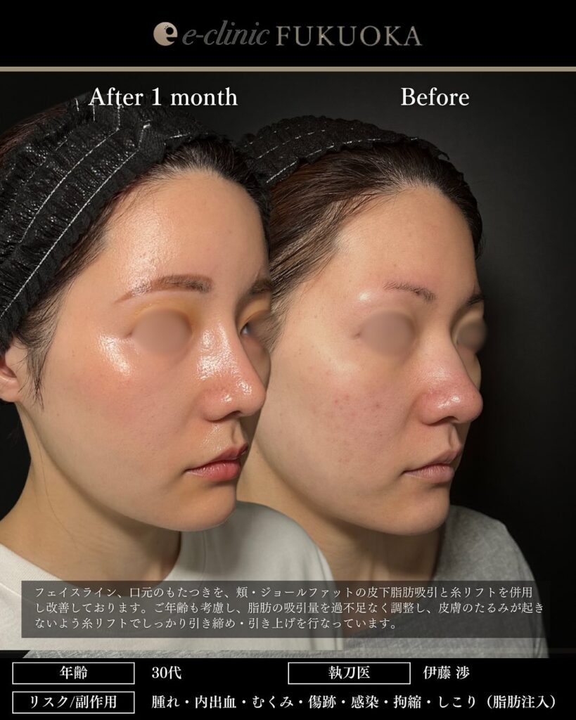 鼻尖形成と軟骨移植と小鼻縮小とプロテーゼと額とこめかみの脂肪注入と頬の脂肪吸引とジョールファットと糸リフトの症例写真 (3)