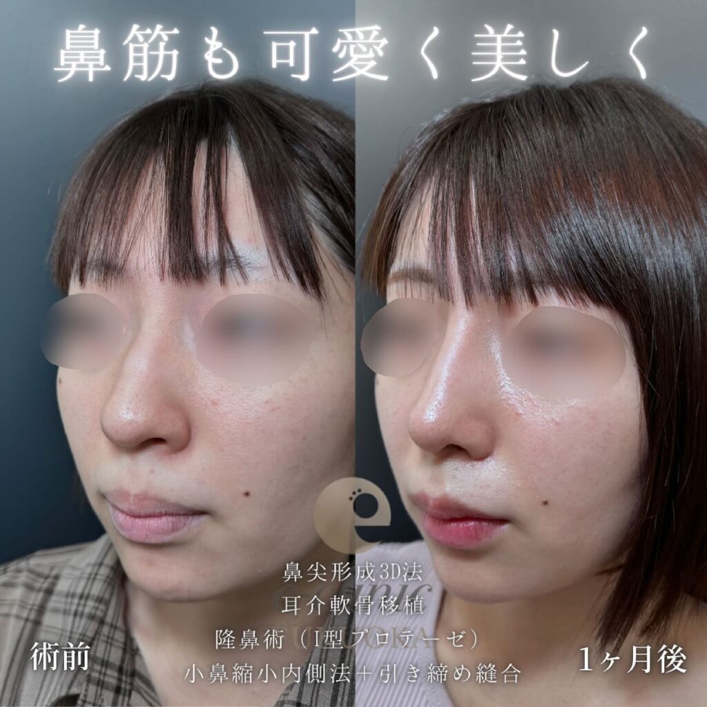 鼻尖形成と軟骨移植とプロテーゼと小鼻縮小の症例写真 (5)