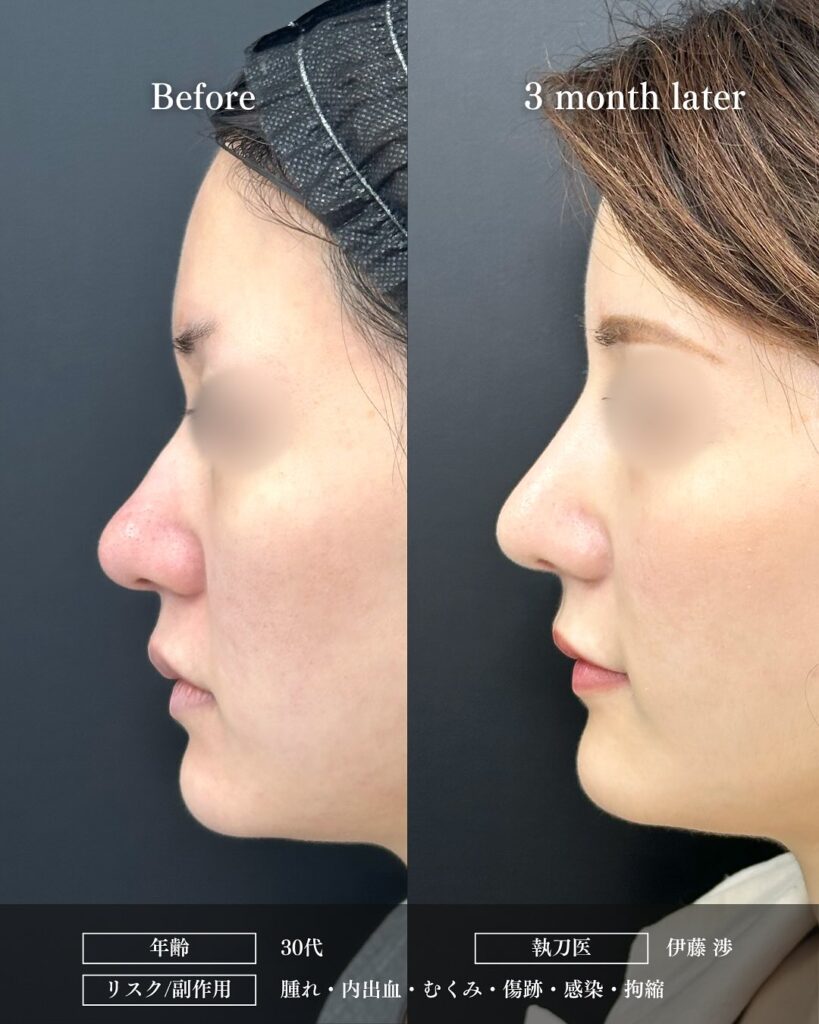 鼻尖形成と軟骨移植とプロテーゼと小鼻縮小と脂肪注入と頬の脂肪吸引とジョールファットと糸リフトの症例写真 (3)