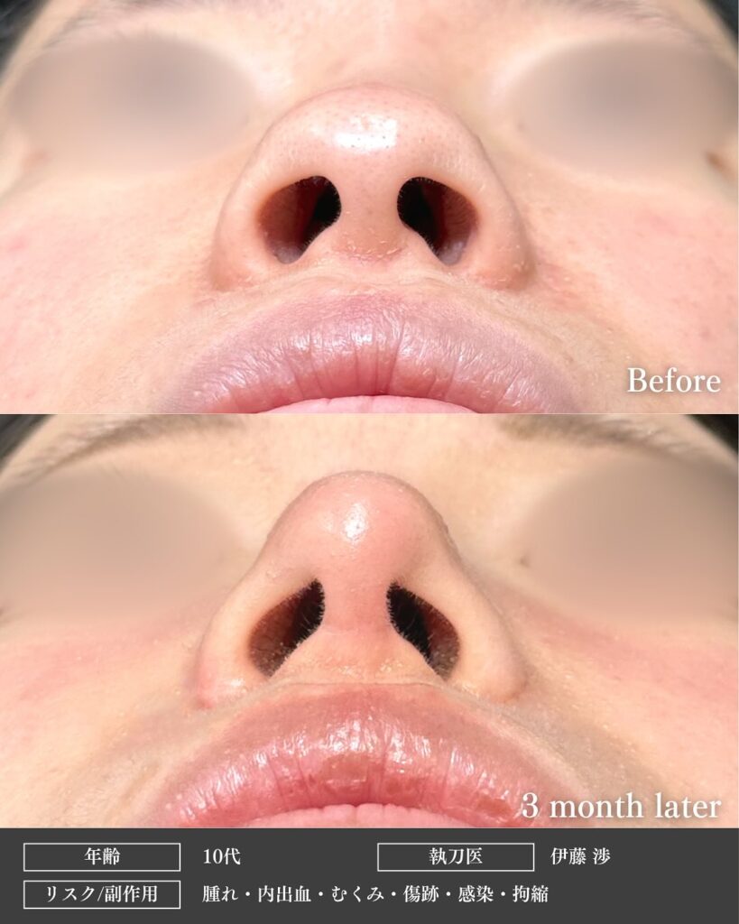 鼻尖形成と軟骨移植と小鼻縮小の症例写真 (35)