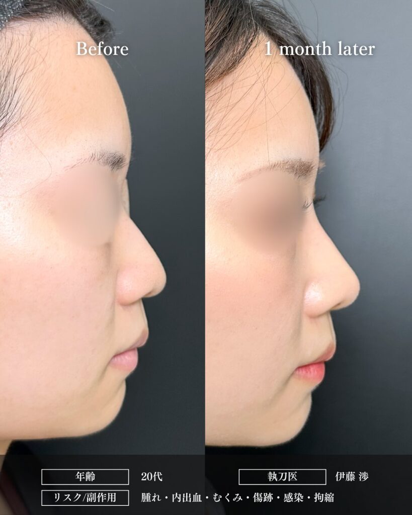 鼻尖形成と軟骨移植とプロテーゼの症例写真 (18)