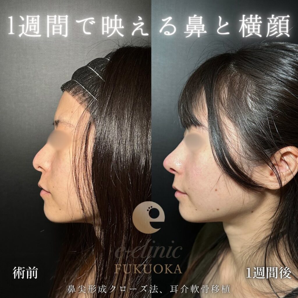 鼻尖形成と軟骨移植の症例写真 (9)