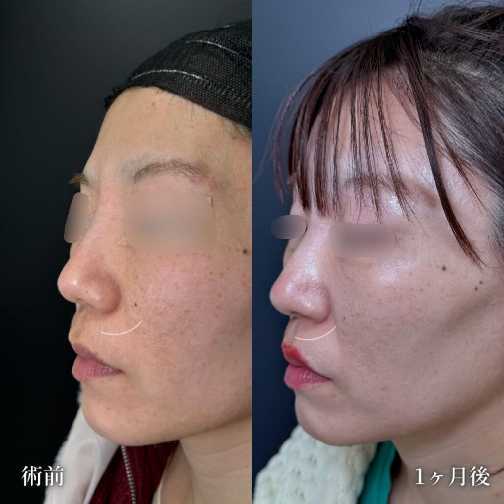 鼻孔縁挙上の症例写真 (3)